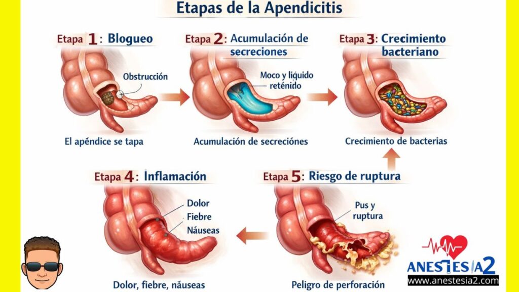 cuáles son las consecuencias de una apendicitis